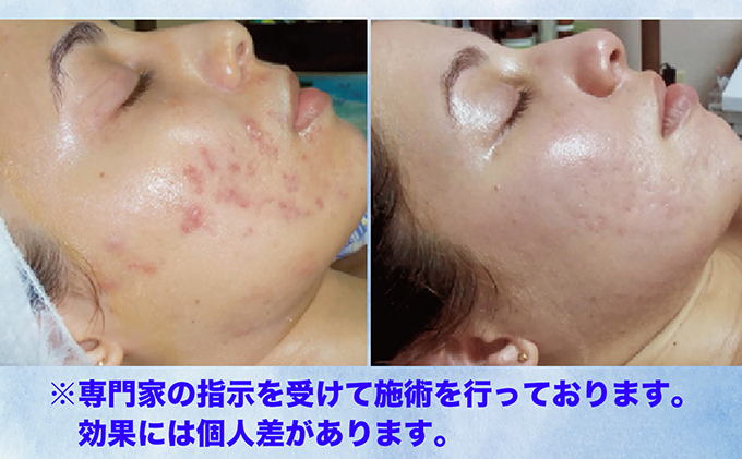 フェイシャルエステお試し1回（70分）利用券 美容 美顔 美肌 プライベートエステ エステ 厳選 人気 袋井市 体験 チケット 美顔器 リゼネレート 目元 唇 集中ケア 毛穴 シワ タルミ ニキビ ニキビ跡 ハリ ツヤ ナノスタンプ技術 引き締め 