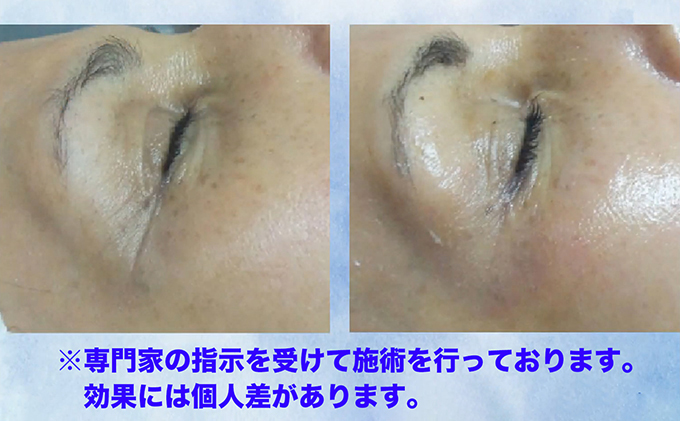 フェイシャルエステ回数券10回分（70分／回）美容 美顔 美肌 プライベートエステ エステ 厳選 人気 袋井市 体験 チケット 美顔器 リゼネレート 目元 唇 集中ケア 毛穴 シワ タルミ ニキビ ニキビ跡 ハリ ツヤ ナノスタンプ技術 引き締め 